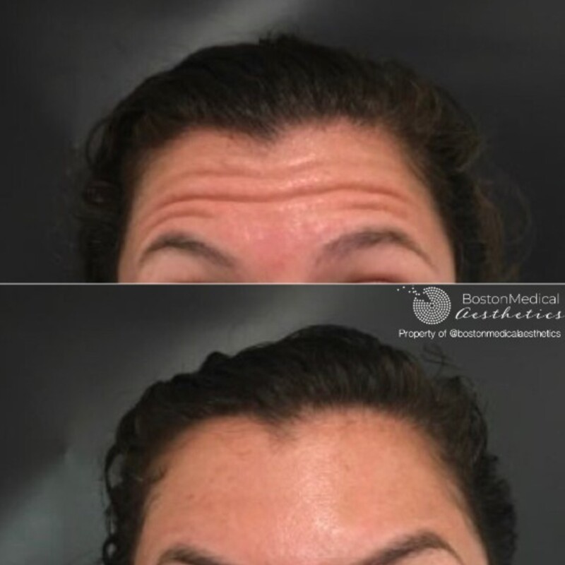 Botox and Dysport Before & After Photo