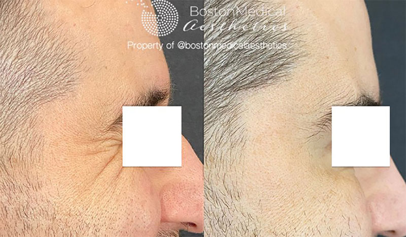Botox and Dysport Before & After Photo