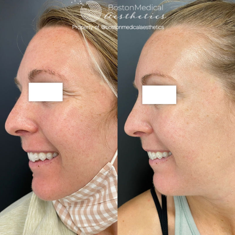 Botox and Dysport Before & After Photo