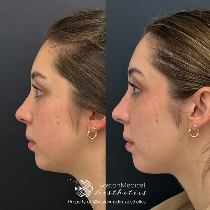 Cheek Filler Before & After Photo
