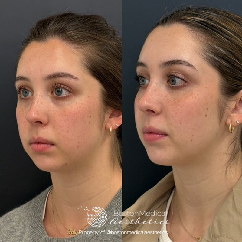 Cheek Filler Before & After Photo