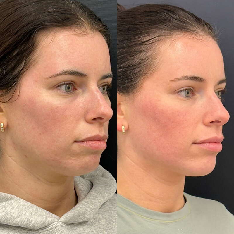 Cheek Filler Before & After Photo