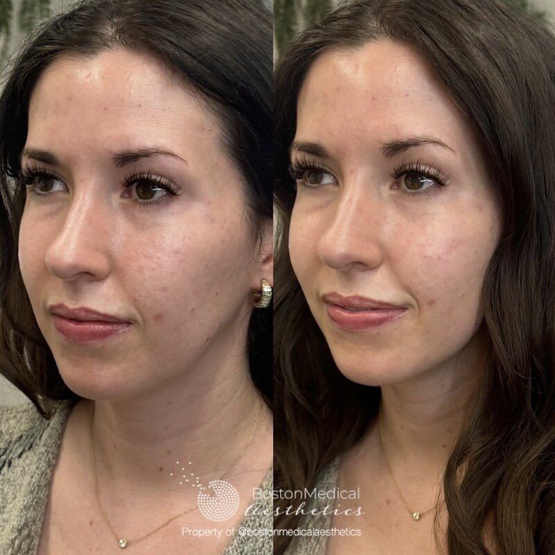 Cheek Filler Before & After Photo