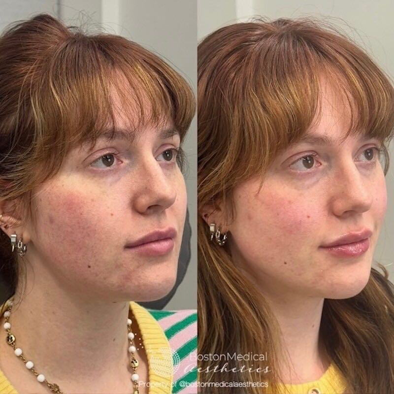 Cheek Filler Before & After Photo