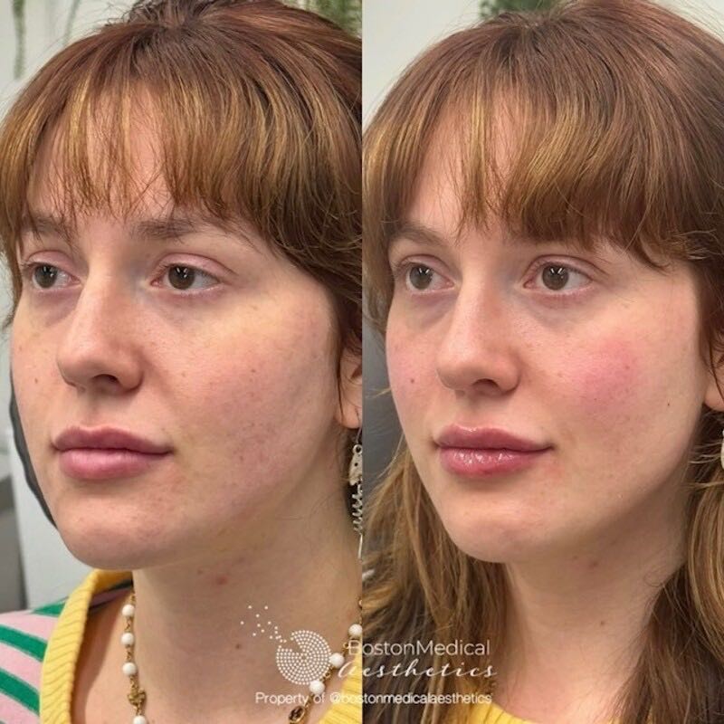 Cheek Filler Before & After Photo