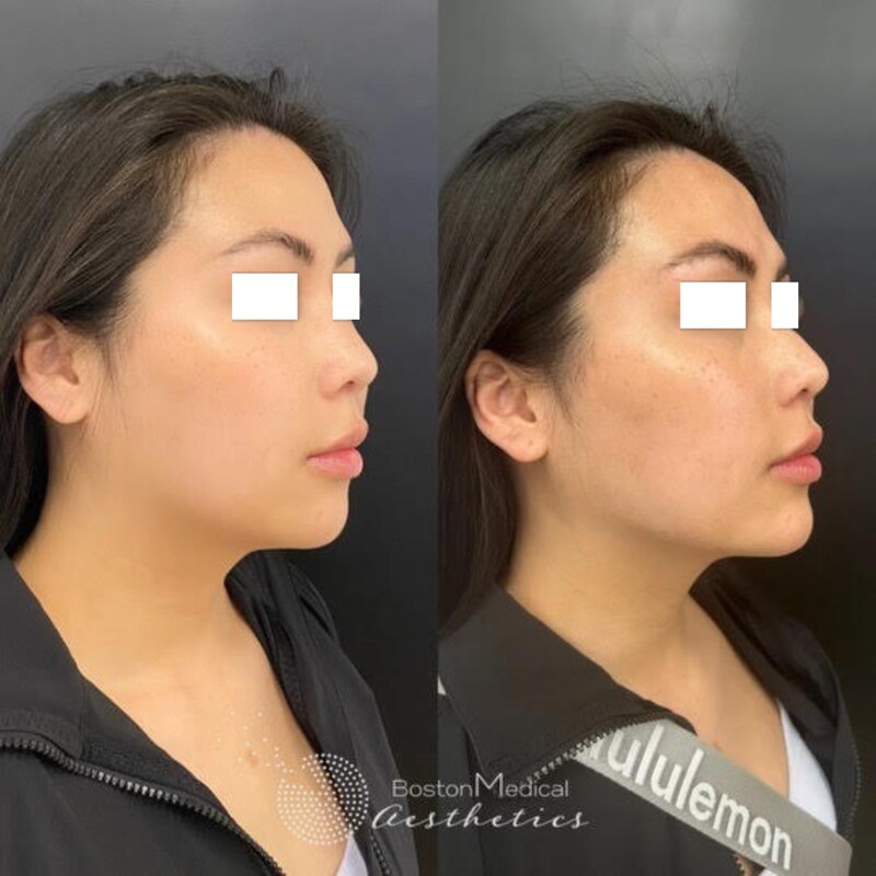 Cheek Filler Before & After Photo
