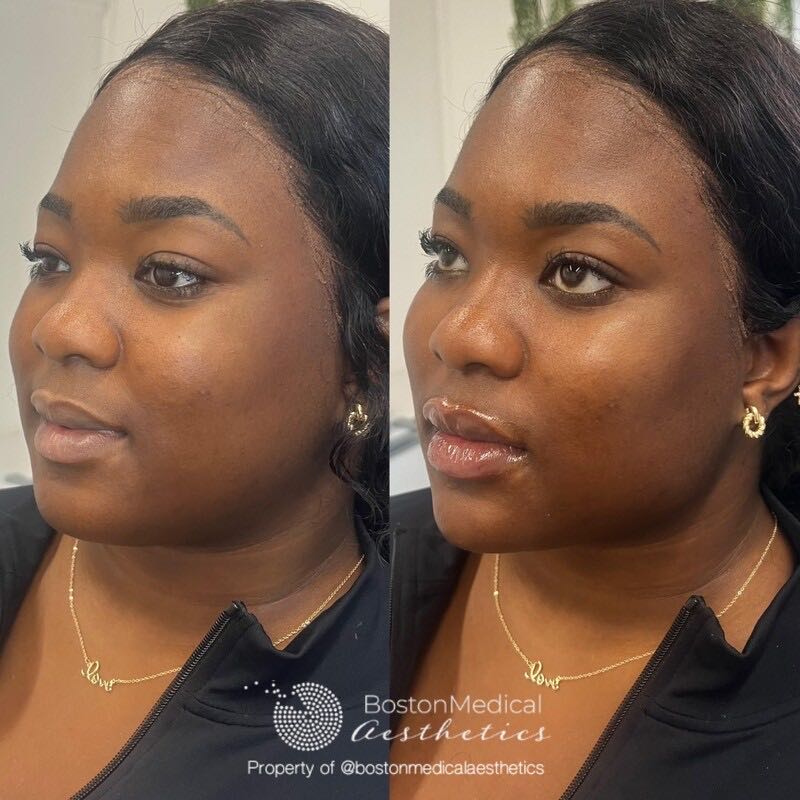 Cheek Filler Before & After Photo