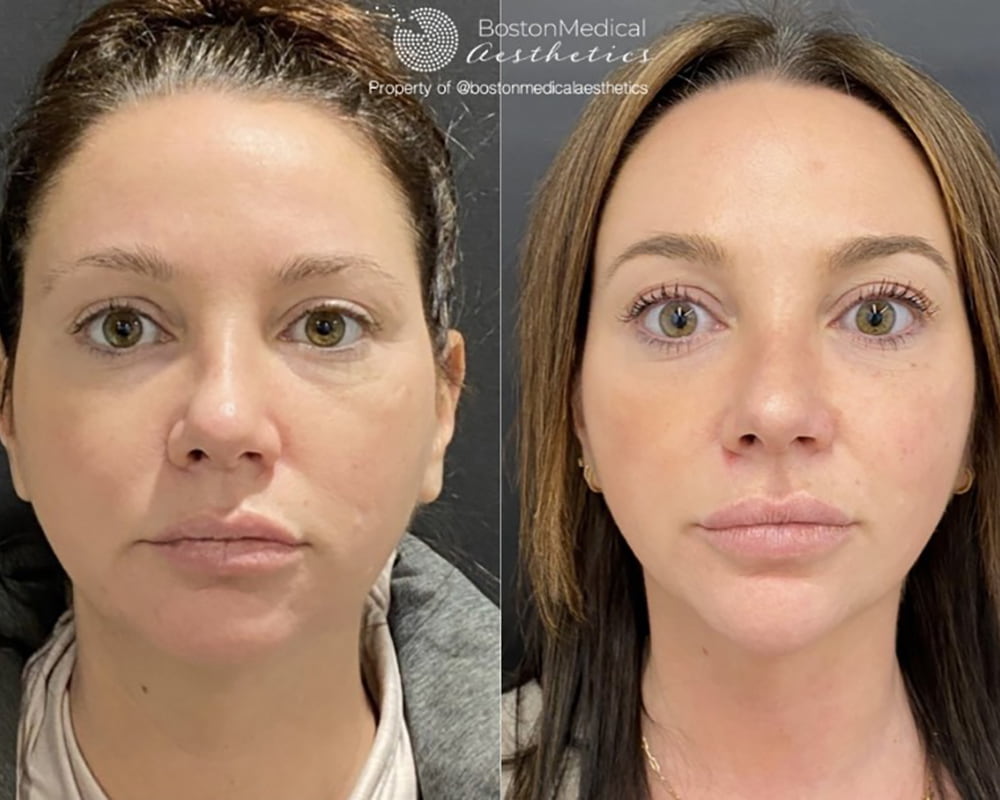 Cheek Filler Before & After Photo