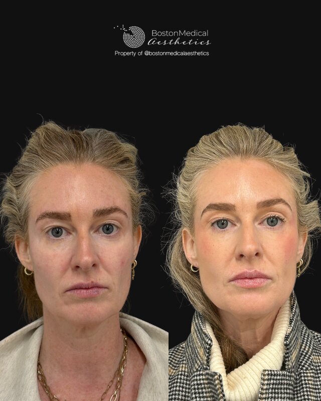 Cheek Filler Before & After Photo