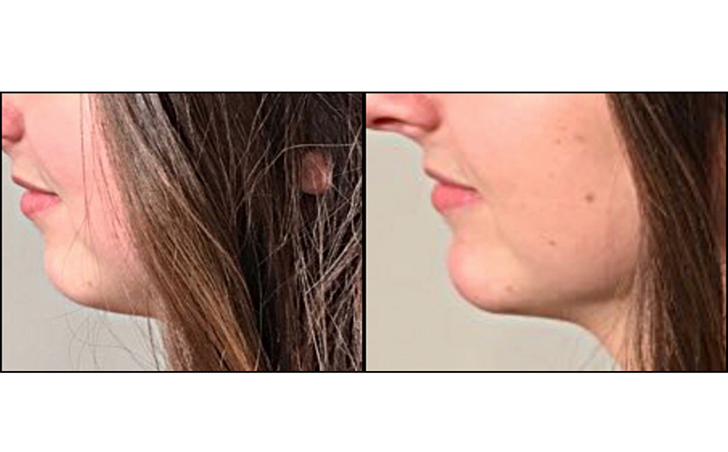 Chin Augmentation Before & After Photo