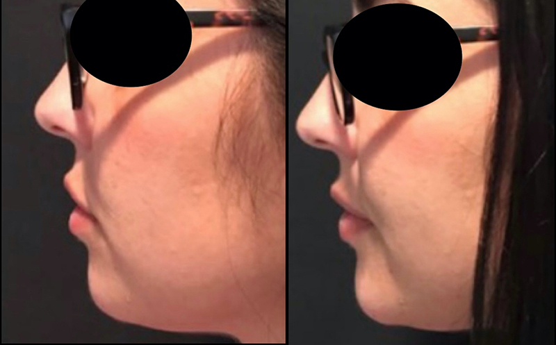 Chin Augmentation Before & After Photo