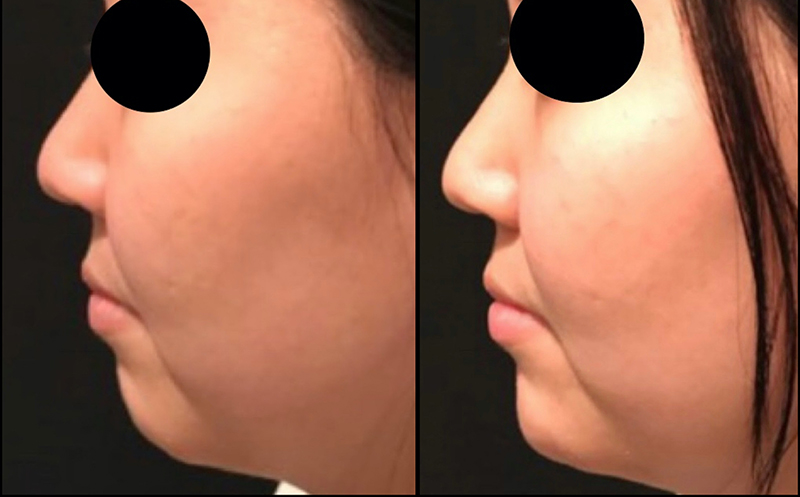 Chin Augmentation Before & After Photo