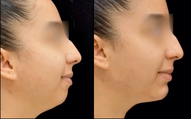 Chin Augmentation Before & After photo