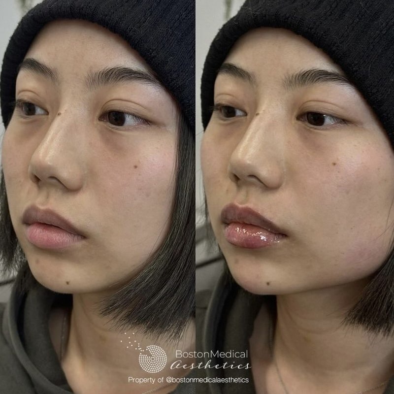 Chin Augmentation Before & After Photo
