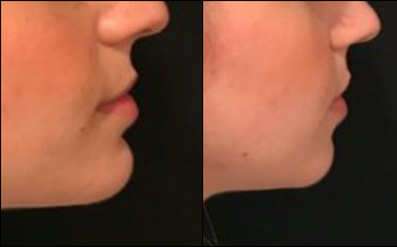 Chin Augmentation Before & After Photo