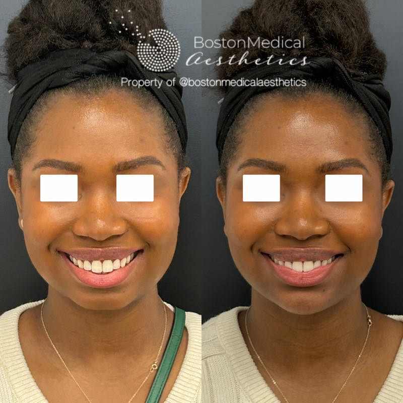 Chin Augmentation Before & After Photo