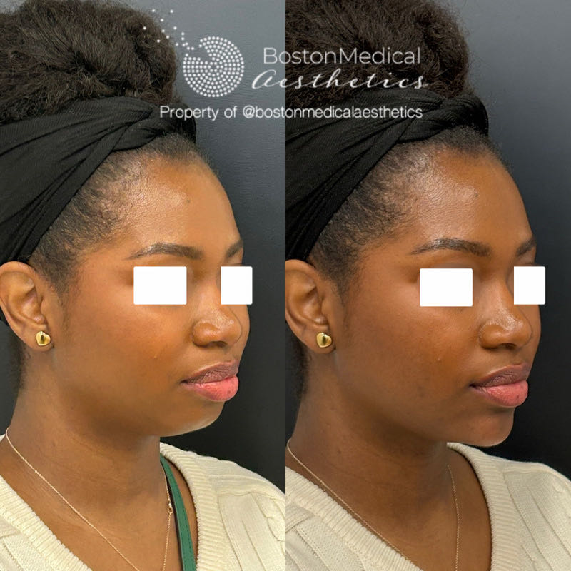 Chin Augmentation Before & After Photo