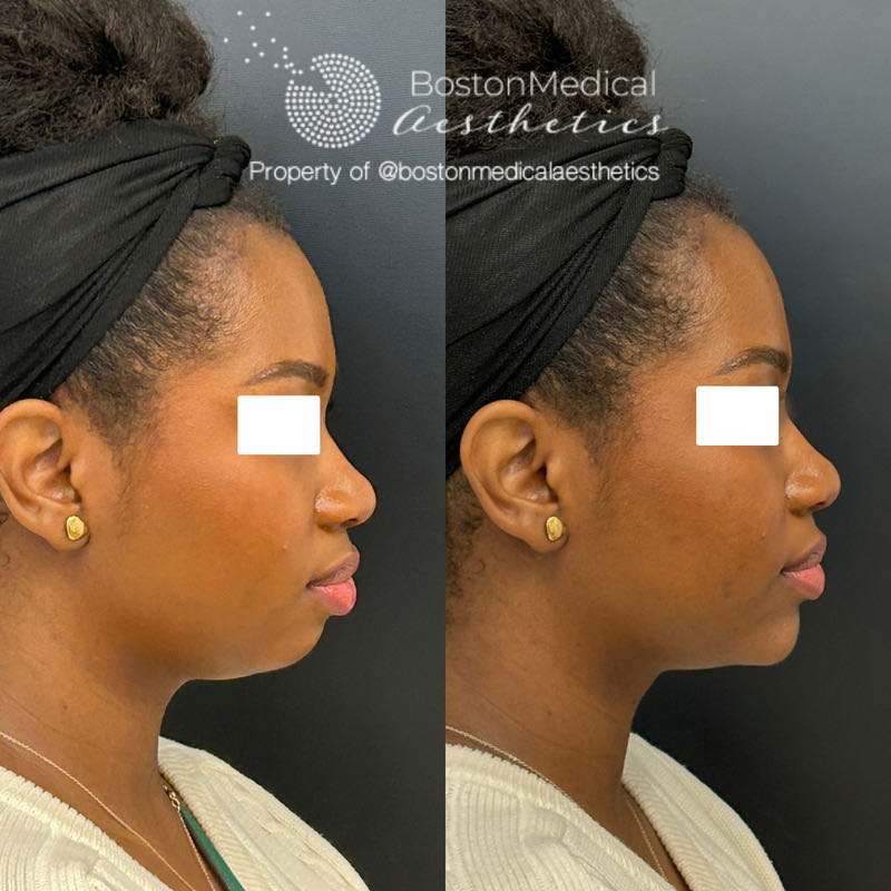 Chin Augmentation Before & After Photo