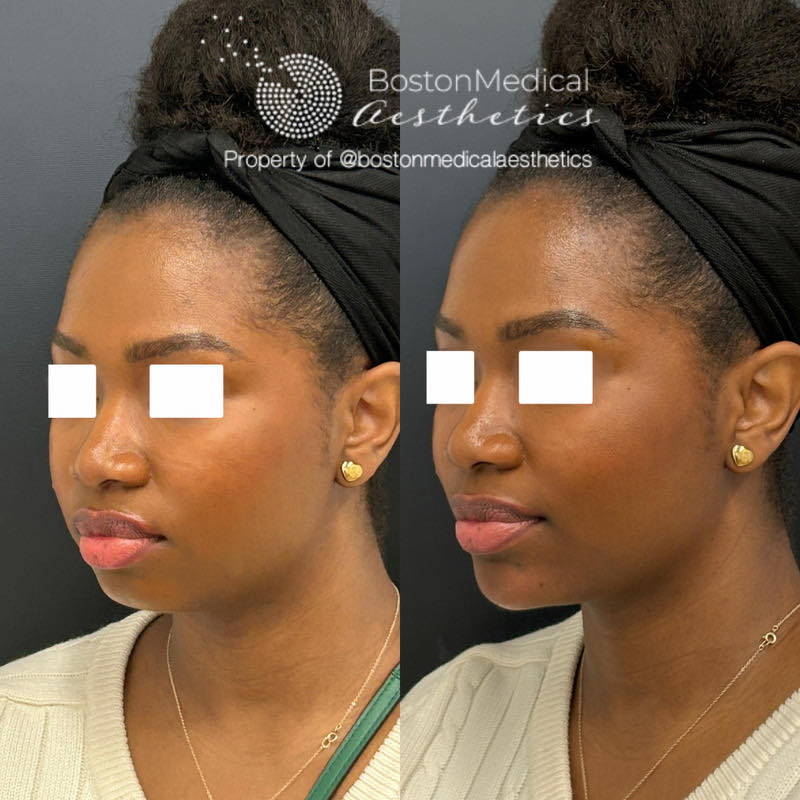 Chin Augmentation Before & After Photo