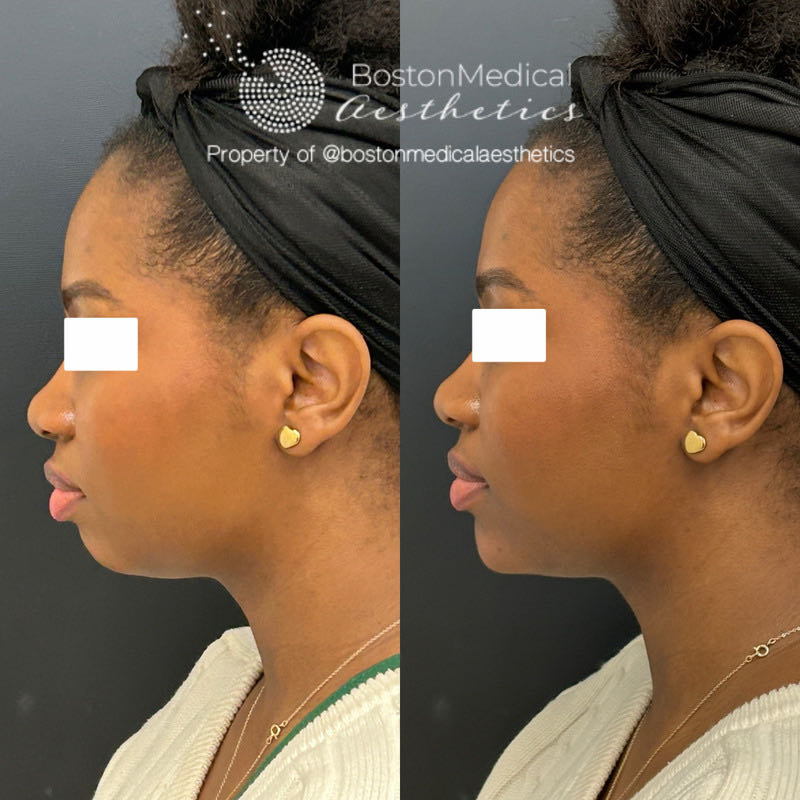Chin Augmentation Before & After Photo