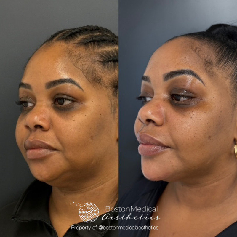 Chin Augmentation Before & After Photo