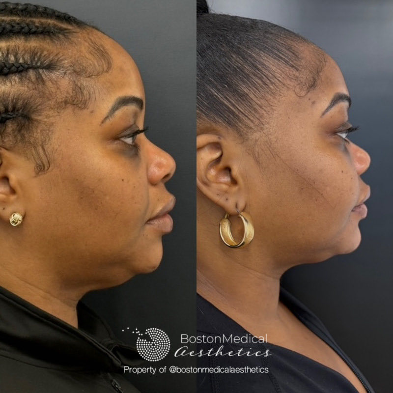 Chin Augmentation Before & After Photo