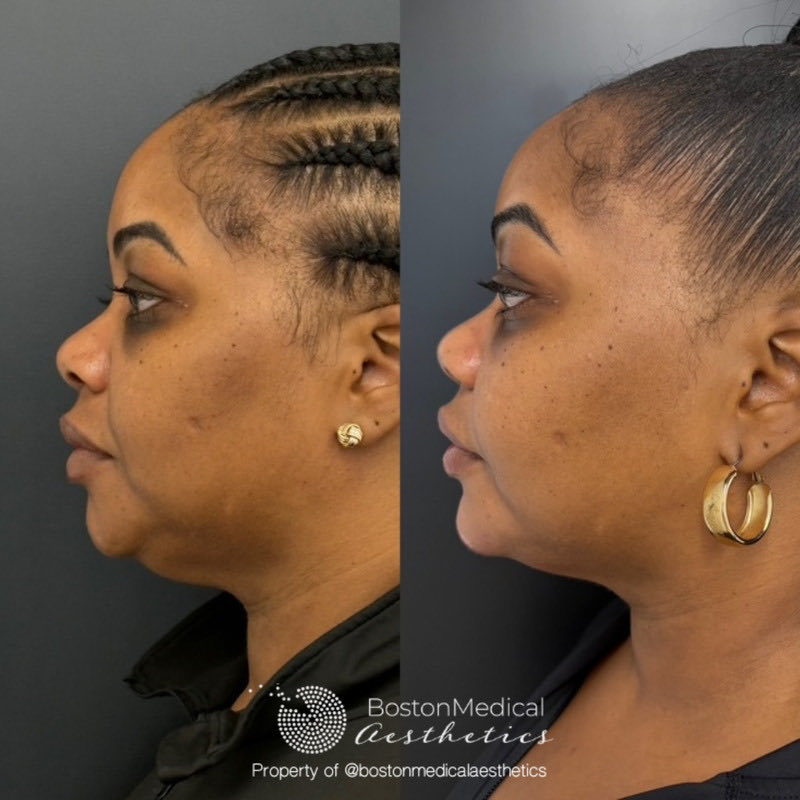 Chin Augmentation Before & After Photo