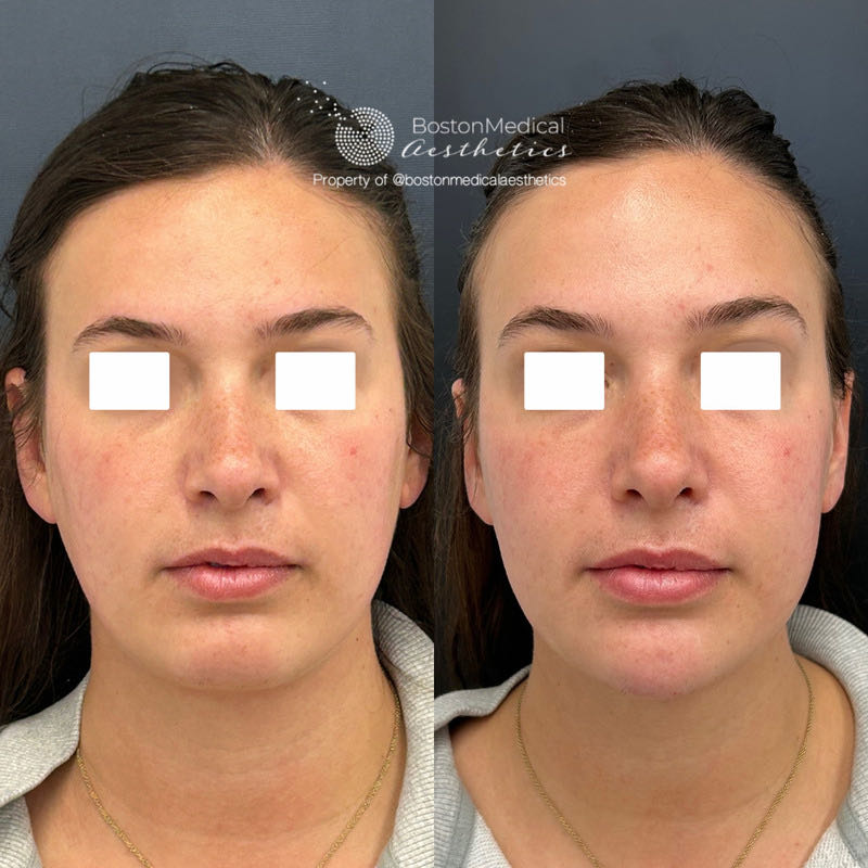 Chin Augmentation Before & After Photo