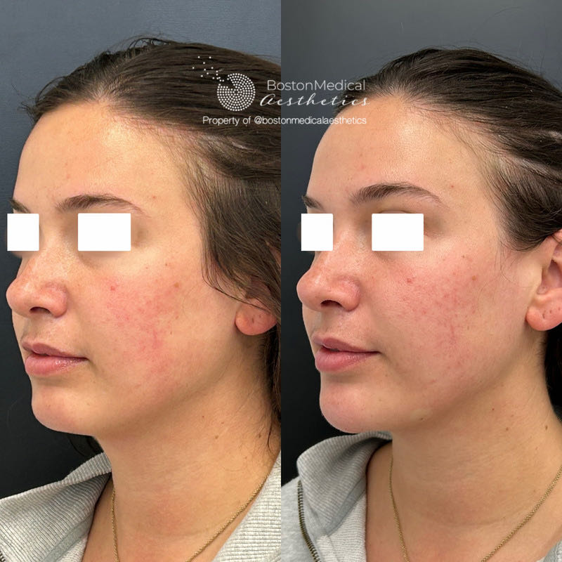 Chin Augmentation Before & After Photo