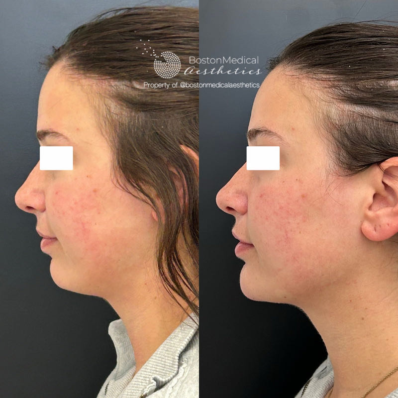 Chin Augmentation Before & After Photo