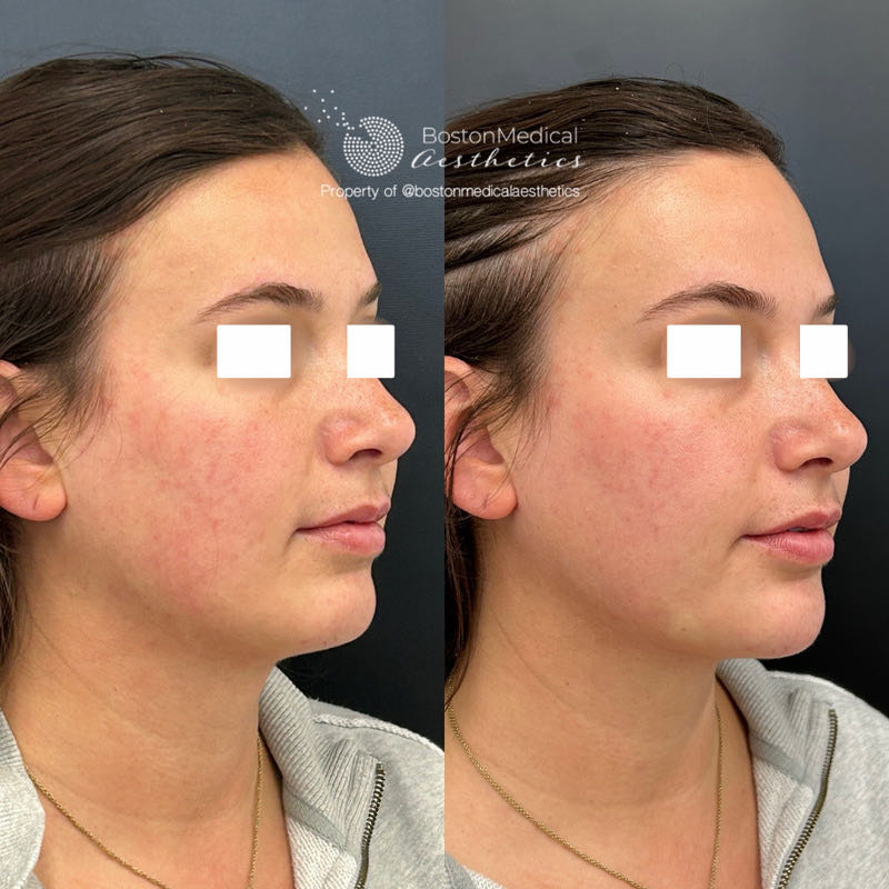 Chin Augmentation Before & After Photo