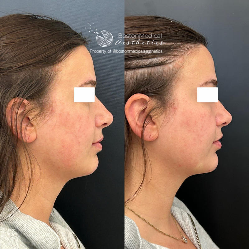 Chin Augmentation Before & After Photo