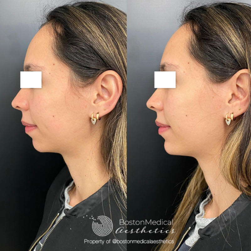 Chin Augmentation Before & After Photo