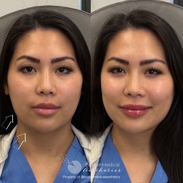 Chin Augmentation Before & After Photo