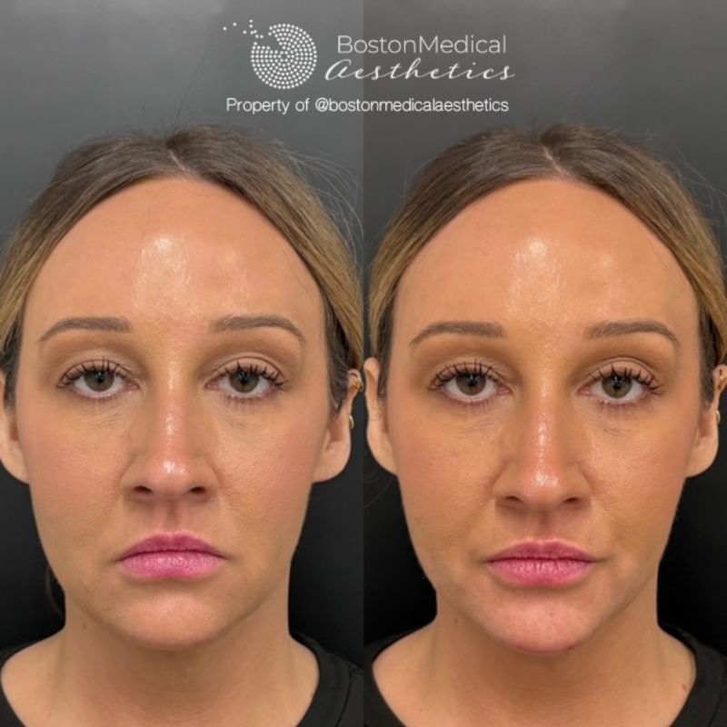 Chin Augmentation Before & After Photo