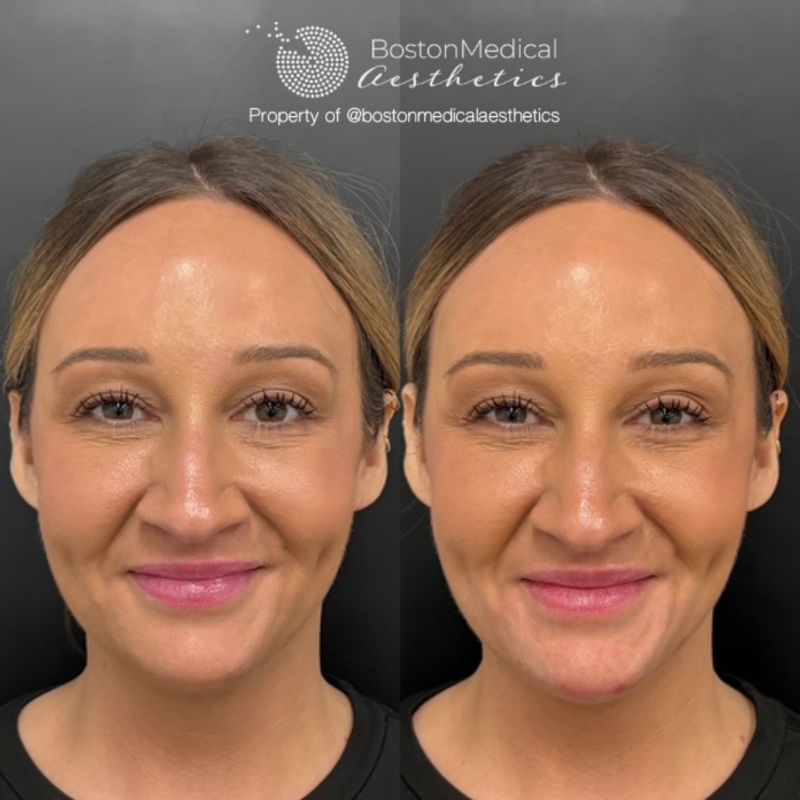 Chin Augmentation Before & After Photo