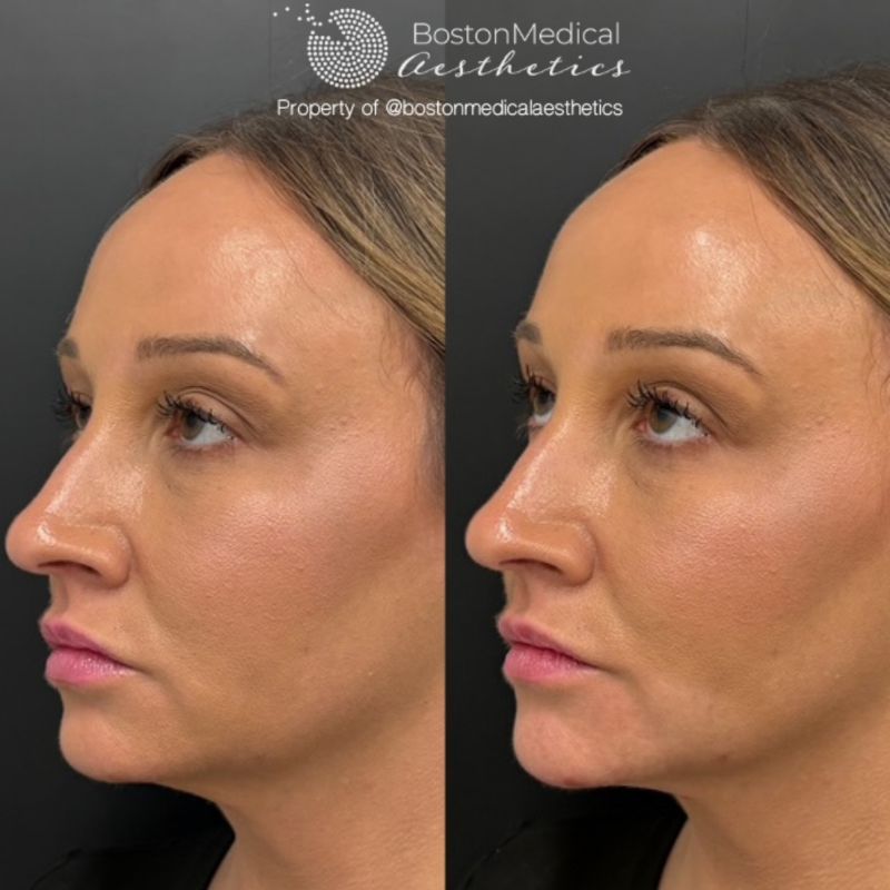 Chin Augmentation Before & After Photo