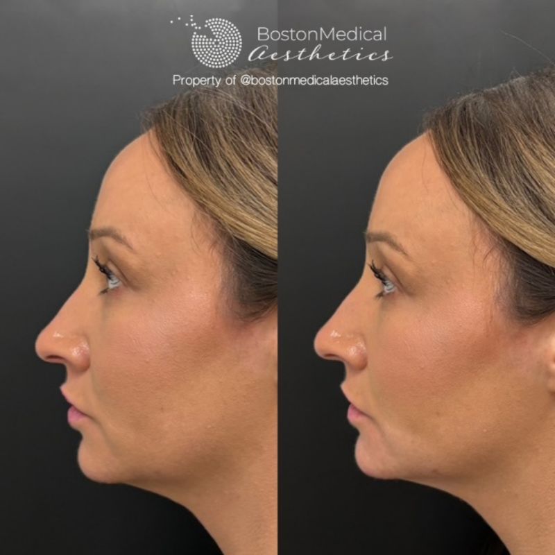 Chin Augmentation Before & After Photo
