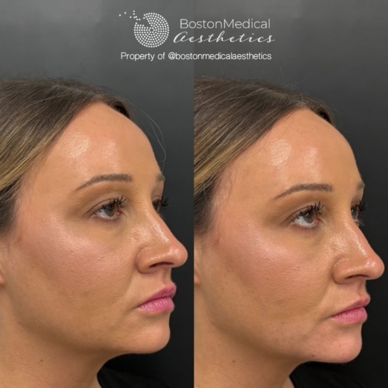 Chin Augmentation Before & After Photo
