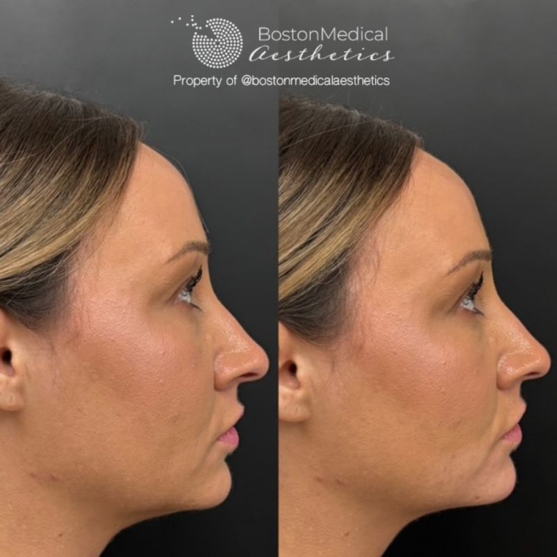 Chin Augmentation Before & After Photo