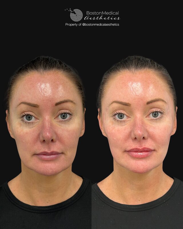 Chin Augmentation Before & After Photo