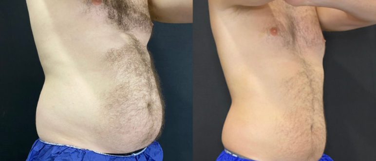 CoolSculpting Elite Before & After Photo