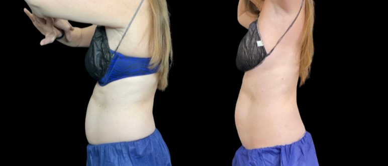 CoolSculpting Elite Before & After Photo