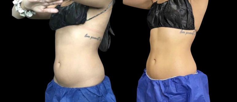 CoolSculpting Elite Before & After Photo