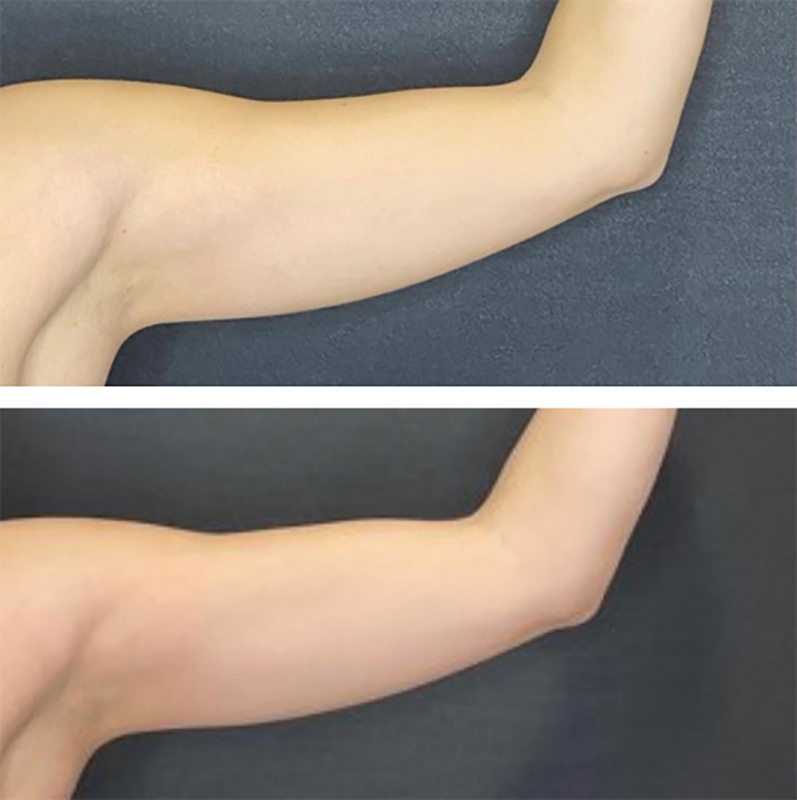 CoolSculpting Before & After photo