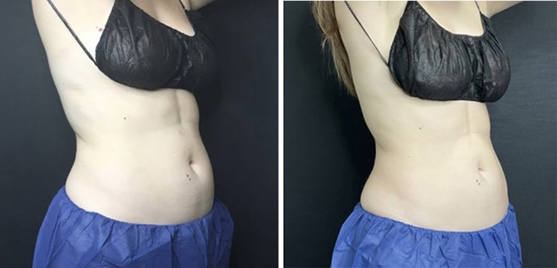 CoolSculpting Before & After Photo