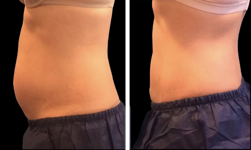 CoolSculpting Before & After Photo