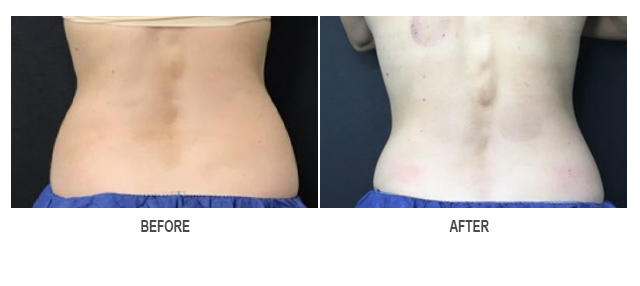 CoolSculpting Before & After Photo