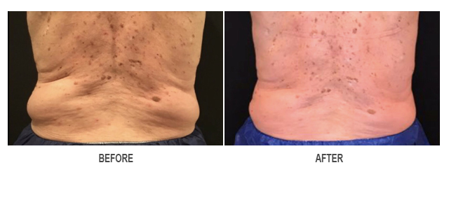 CoolSculpting Before & After Photo