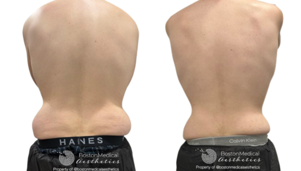 CoolSculpting Before & After Photo